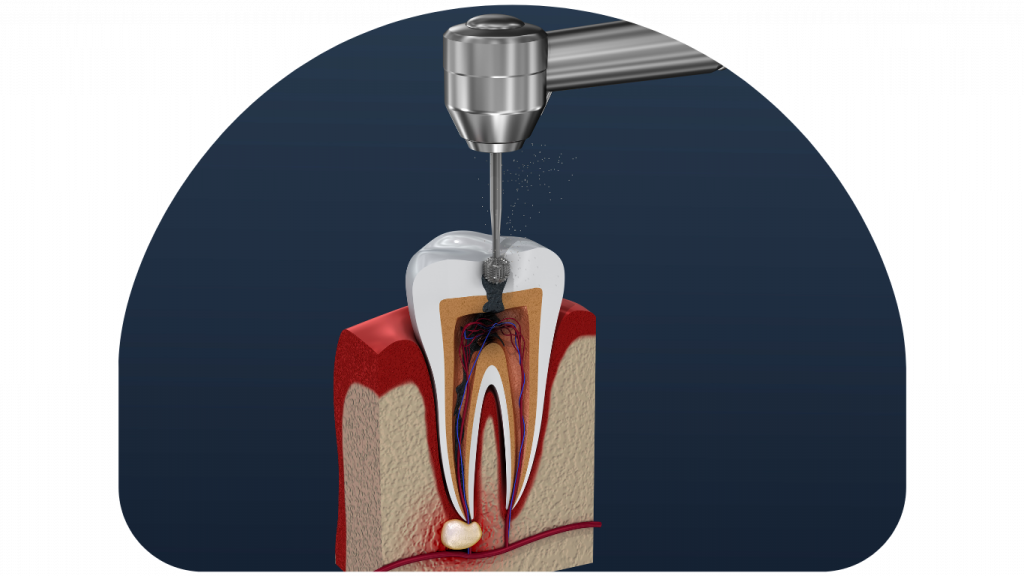 Automated root canal treatment