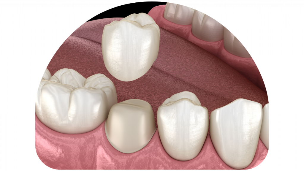 Ceramic and zirconia crowns and bridges