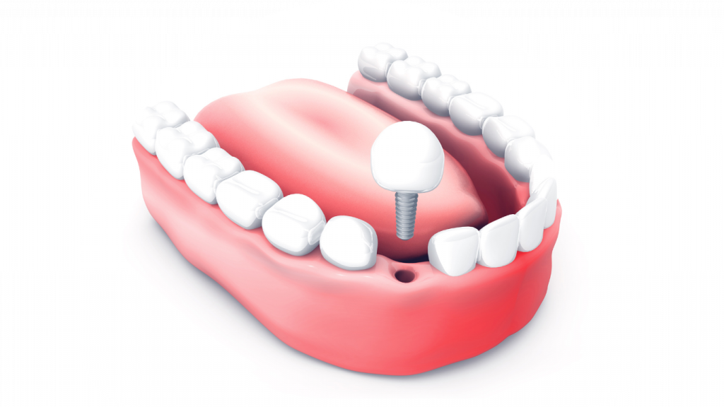 Dental implants for teeth replacement