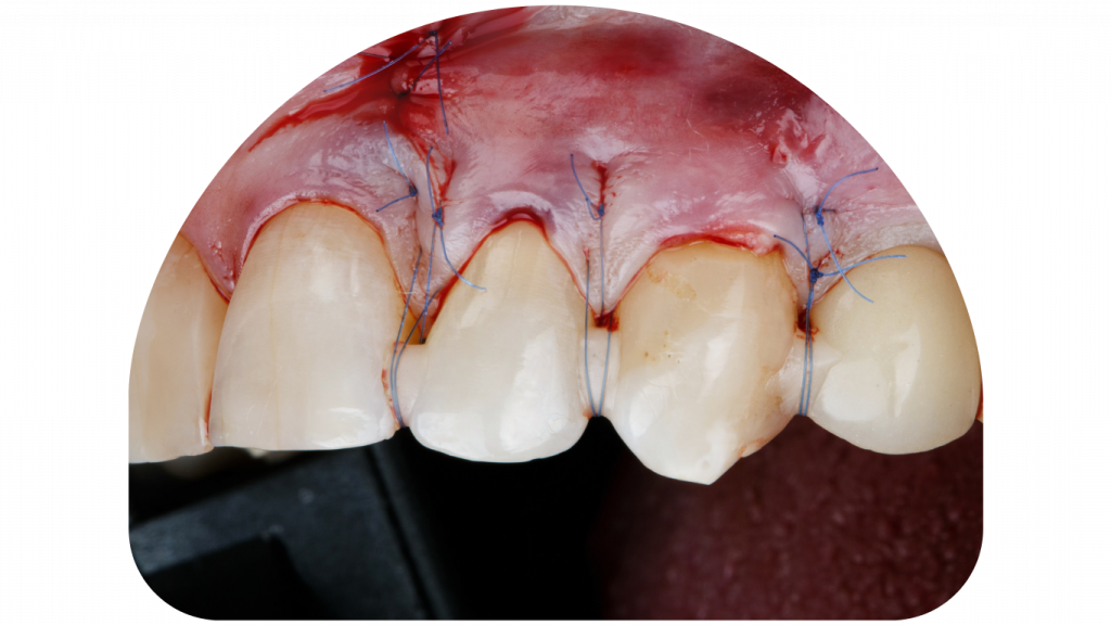 Flap surgeries for gum treatment