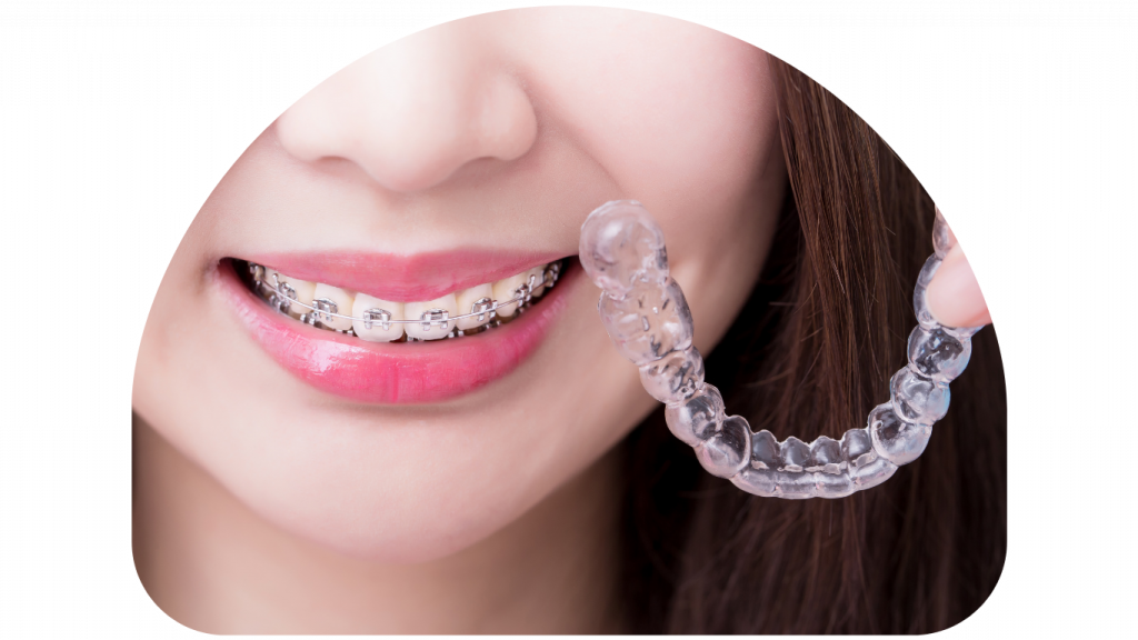 Smile correction with braces