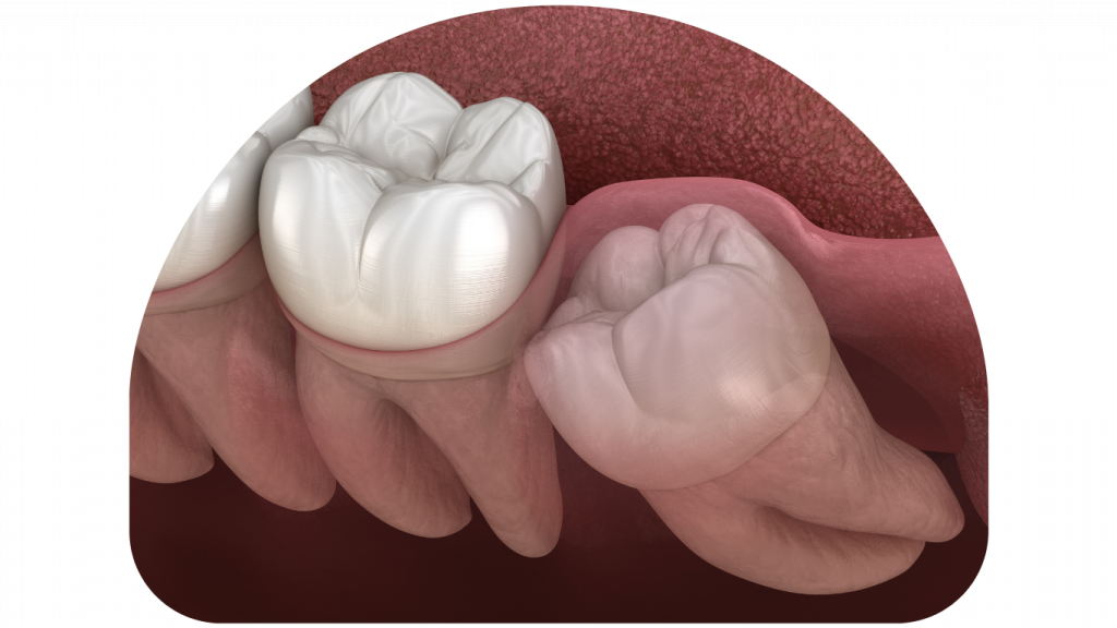 Surgical removal of wisdom teeth