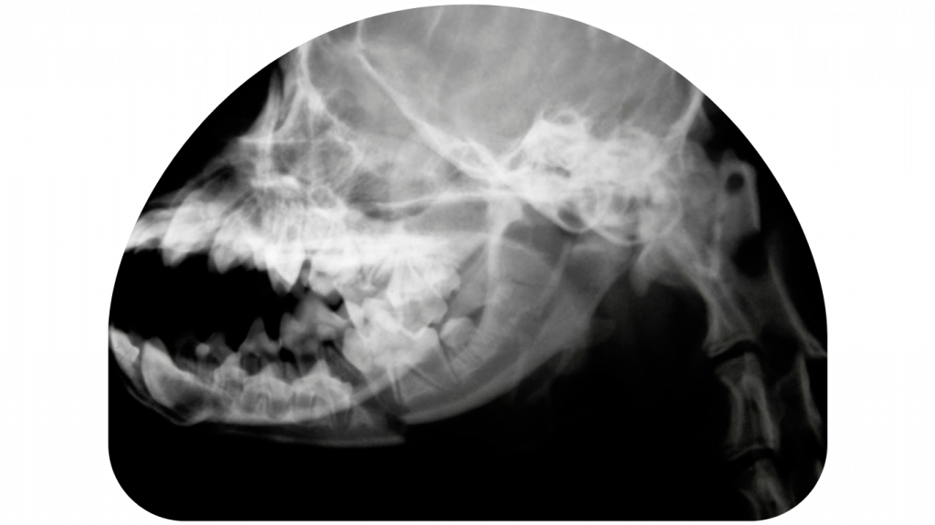 mandiable fracture of jaws