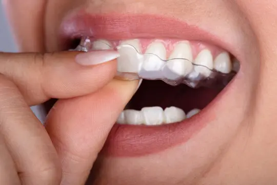 Clear Aligners Whitening Chennai