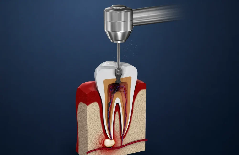 Root Canal Treatment Chennai