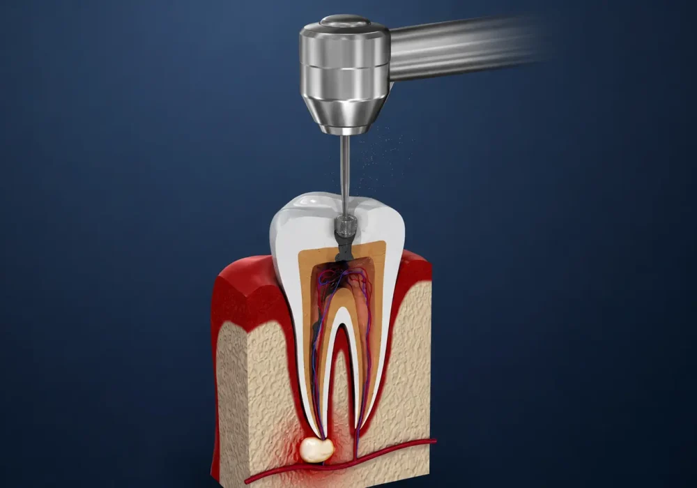 Root Canal Treatment Chennai