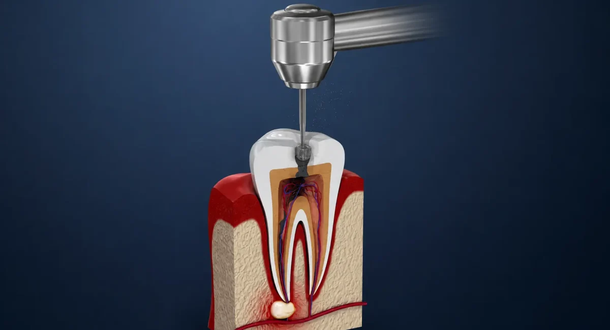 Root Canal Treatment Chennai
