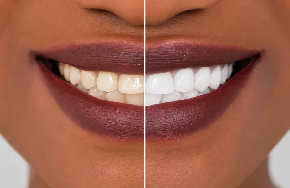 Teeth whitening Chennai