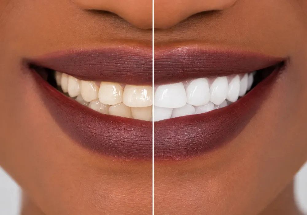Teeth whitening Chennai